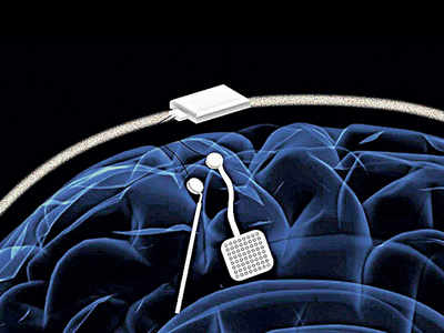‘Brain pacemaker’ could help treat Parkinson’s disease, epilepsy