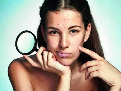 Say goodbye to forehead acne: Tips for pimple-free zone