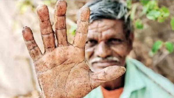 Wagholi stone quarry workers get no rations as fading fingerprints fail to record biometrics