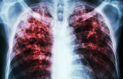1 million Indian TB patients fall off radar every year