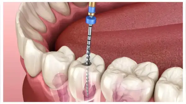 Poor oral health can lead to heart disease