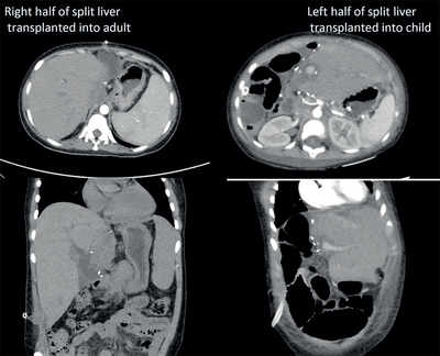 Bengaluru docs ace split liver transplant, save 32-month-old