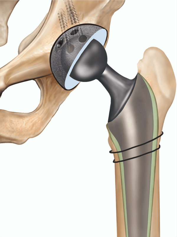 91-year-old Mumbai resident’s hip surgery highlights rise in elderly joint replacements