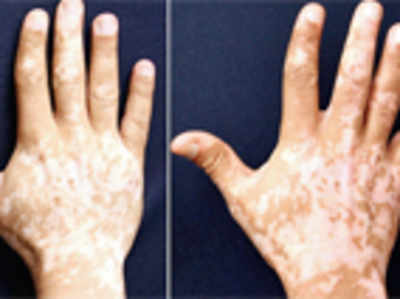 New vitiligo treatment may help restore skin pigmentation