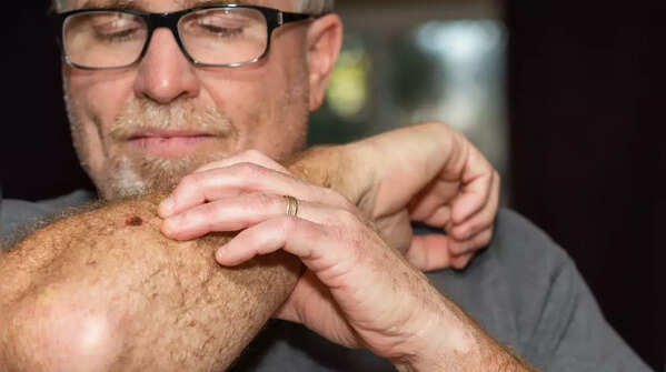 Use the ABCDE rule for moles