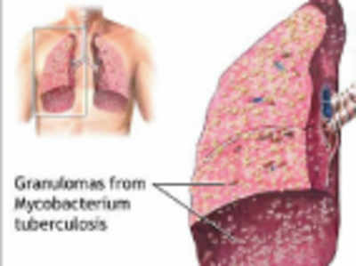 Anti-TB human immunity mastered