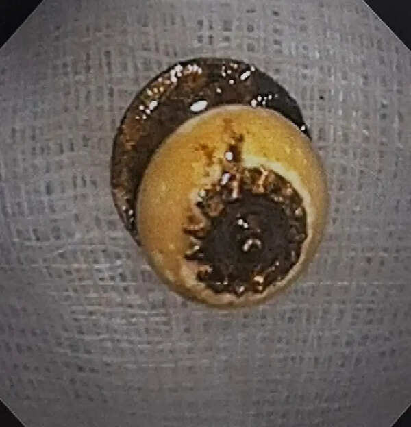 79-year-old swallows button in sleep, safe after op at city hosp