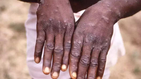 Doctors rule out monkeypox in case reported from Palamu