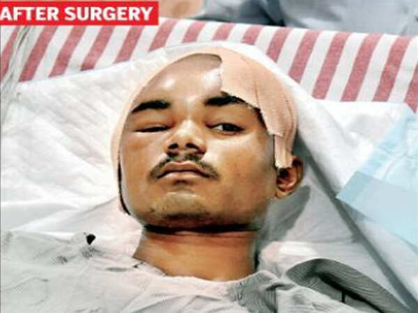 Iron rod pierces brain; Maharashtra man, 21, lives to tell tale