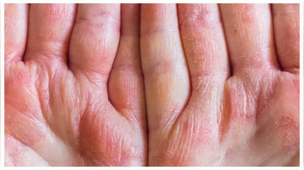 Eczema Flares