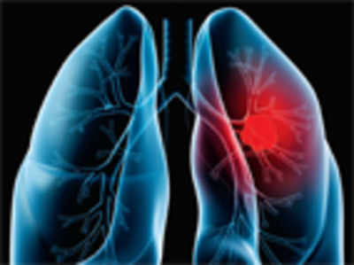 Efforts  on to cap  the spread of lung cancer