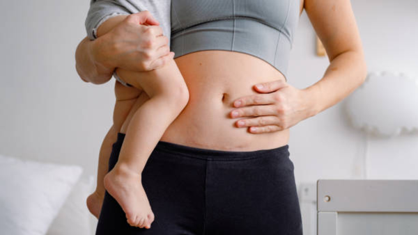 Caesarean section myths debunked: What every expecting parent needs to know