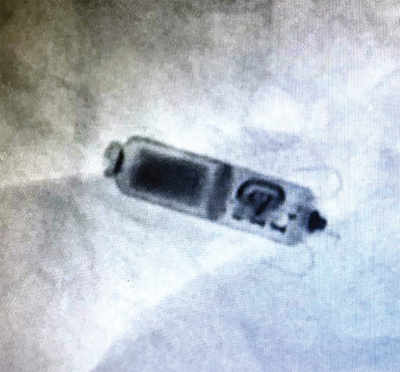 Leadless pacemaker saves obese cancer patient