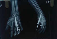 Son attacks man with arrows, critical surgery saves life in Bastar