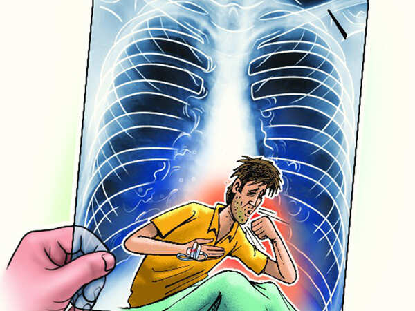 Indore: Jolt to TB-free India mission, 12,000 tested positive in a year