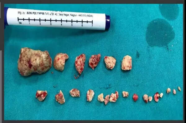 Thought of food hurts? City hospital leads in rare procedure