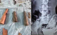 Udaipur: Keys, coins, metal items removed from patient’s stomach 