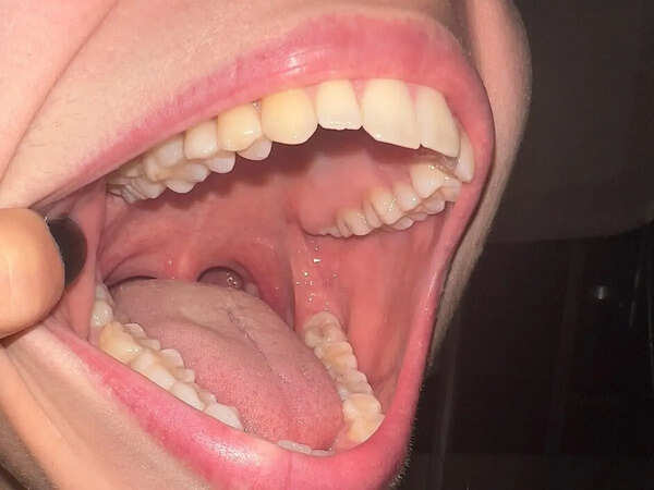 Scientists develop a regenerative therapy that may bring back teeth