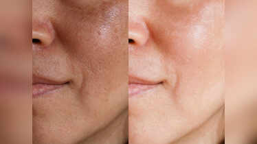 Home remedies to minimise those ugly pores on the face