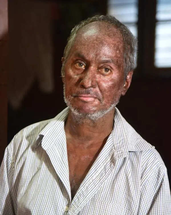 Even today, I spend around Rs 1,000 every 15 days on meds: Blast victim seeks life term for convict