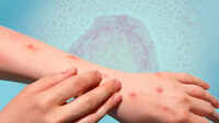 Monkeypox: Things you need to know