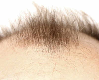 Scientists suggest plucking hair to grow more hair?