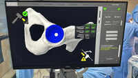 Robotic surgery saves businessman from hip replacement nightmare