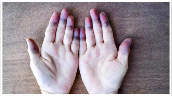 Blue or Purple Skin