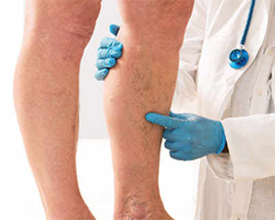 Why you should be wary of varicose veins