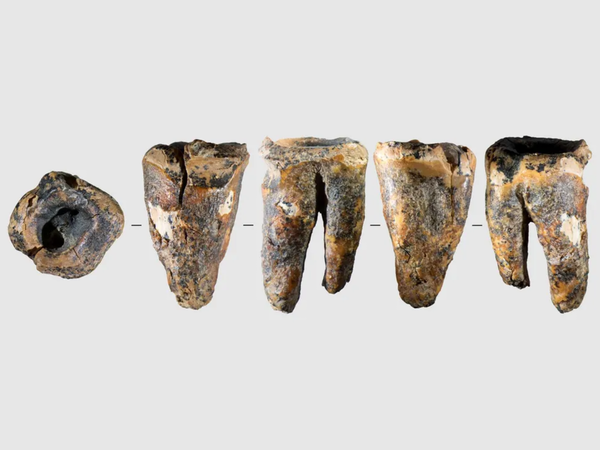 Neanderthals were performing dental surgery nearly 60,000 years ago and it surprisingly worked