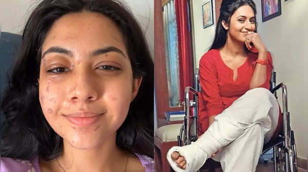 From Reem Shaikh accidentally burning her face on Laughter Chefs to Divyanka Tripathi’s multiple fractures: TV celebs who got severely injured while shooting