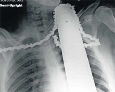 Tree trimmer cheats death after chainsaw pierces his neck