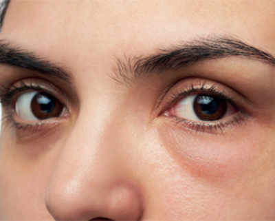 Eye bags and dark circles under eyes treatment: help reduce puffy eyes and  dark eyelids