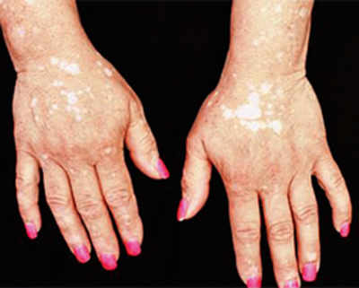 Rheumatoid arthritis drug could hold cure for Vitiligo