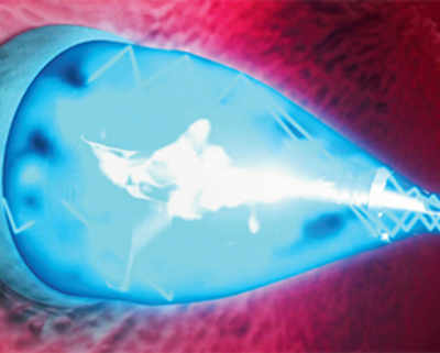 UV light-based device fixes heart defects without surgery