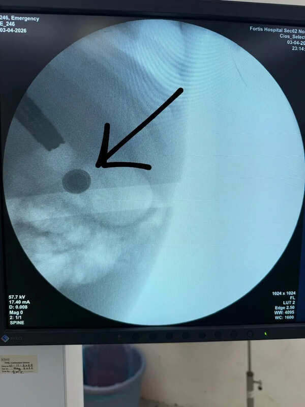 Doctors at Noida hospital save toddler who swallowed lithium battery
