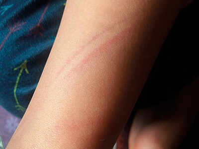 FIR against teacher for beating 9-yr-old girl