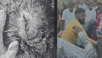Attempt to save injured dog turns violent in Faridabad; rescuer critical, undergoes emergency surgery