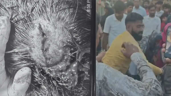 Attempt to save injured dog turns violent in Faridabad; rescuer critical, undergoes emergency surgery