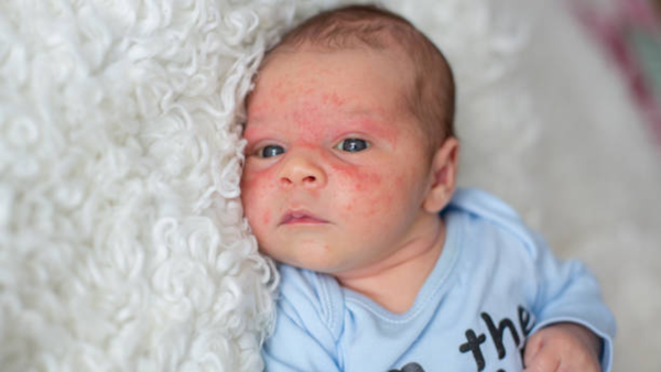 Why is eczema in Indian children on the rise?