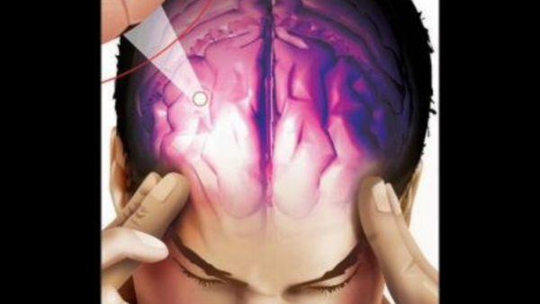 Bengaluru: Man with rare brain infection back on his feet after stroke