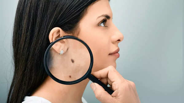 Initial signs of skin cancer and how to spot them