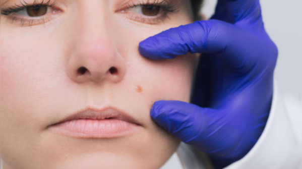 Changes in skin or moles