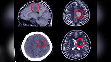Brain Aneurysm Symptoms: Signs that should not be ignored