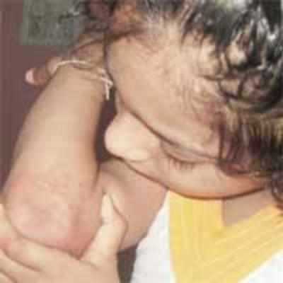 Hand, foot and mouth disease returns to trouble little children