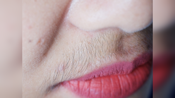 ​Unwanted facial hair