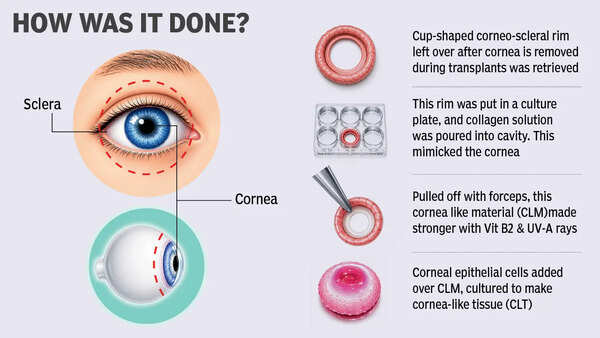 Discarded eye tissue offers hope for cornea shortage