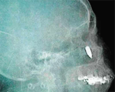 Surgeons find bullet in skull of woman with headache