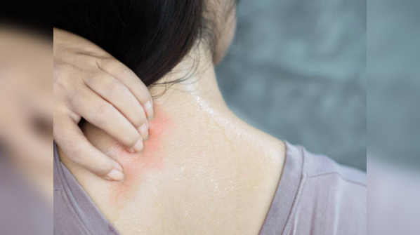 ​Itchiness during summers needs gentle remedies​