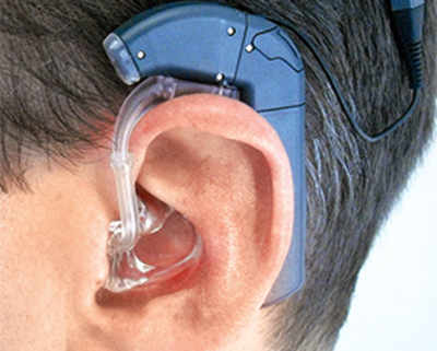 Cochlear implants to skip visible hardware